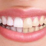 6 natural tooth whitening methods
