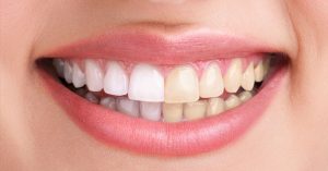 6 natural tooth whitening methods